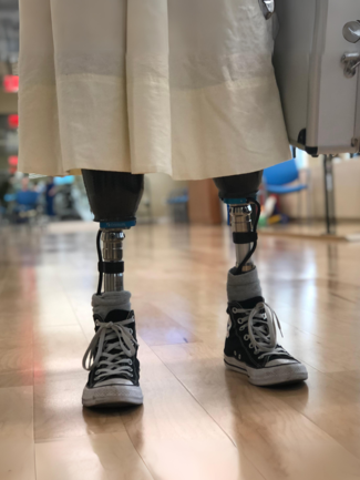 bilateral below the knee prosthetic legs